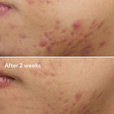 Deep Relief Blemish Treatment